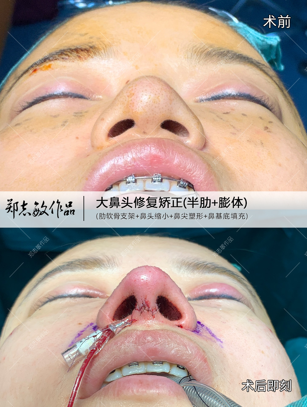 术后即刻】 患者之前外院做过硅胶隆鼻,后期鼻头增生严重,鼻头收缩