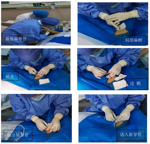 picc导管原位置换术,为"看不见的生命线"保驾护航!