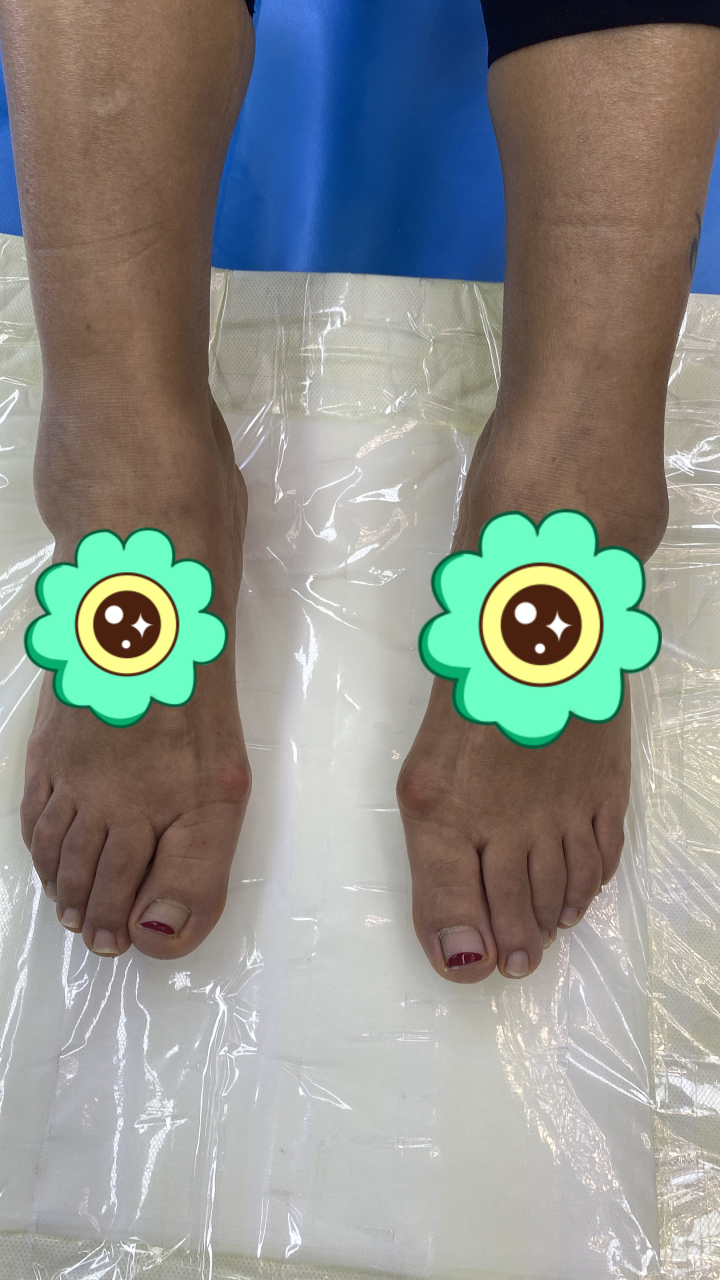 拇外翻,通常指的是大脚趾向外偏斜超过15度的情况,这种状况虽然在外观