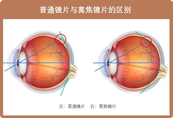 控制近视的周边离焦框架眼镜和角膜塑形镜