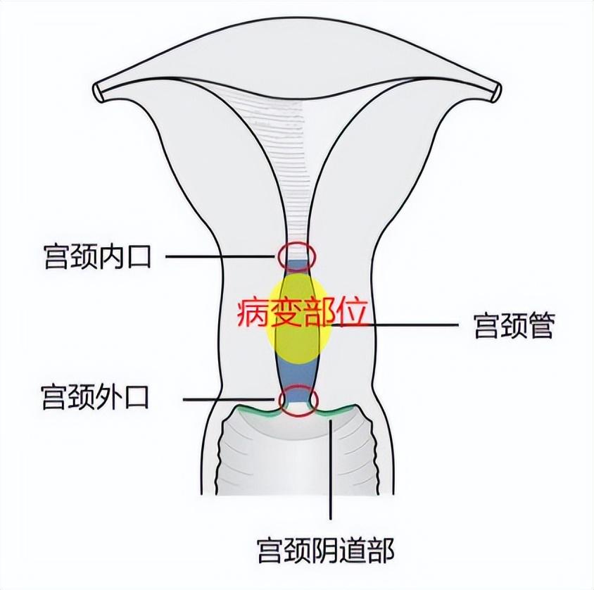 宫颈口在什么位置图图片