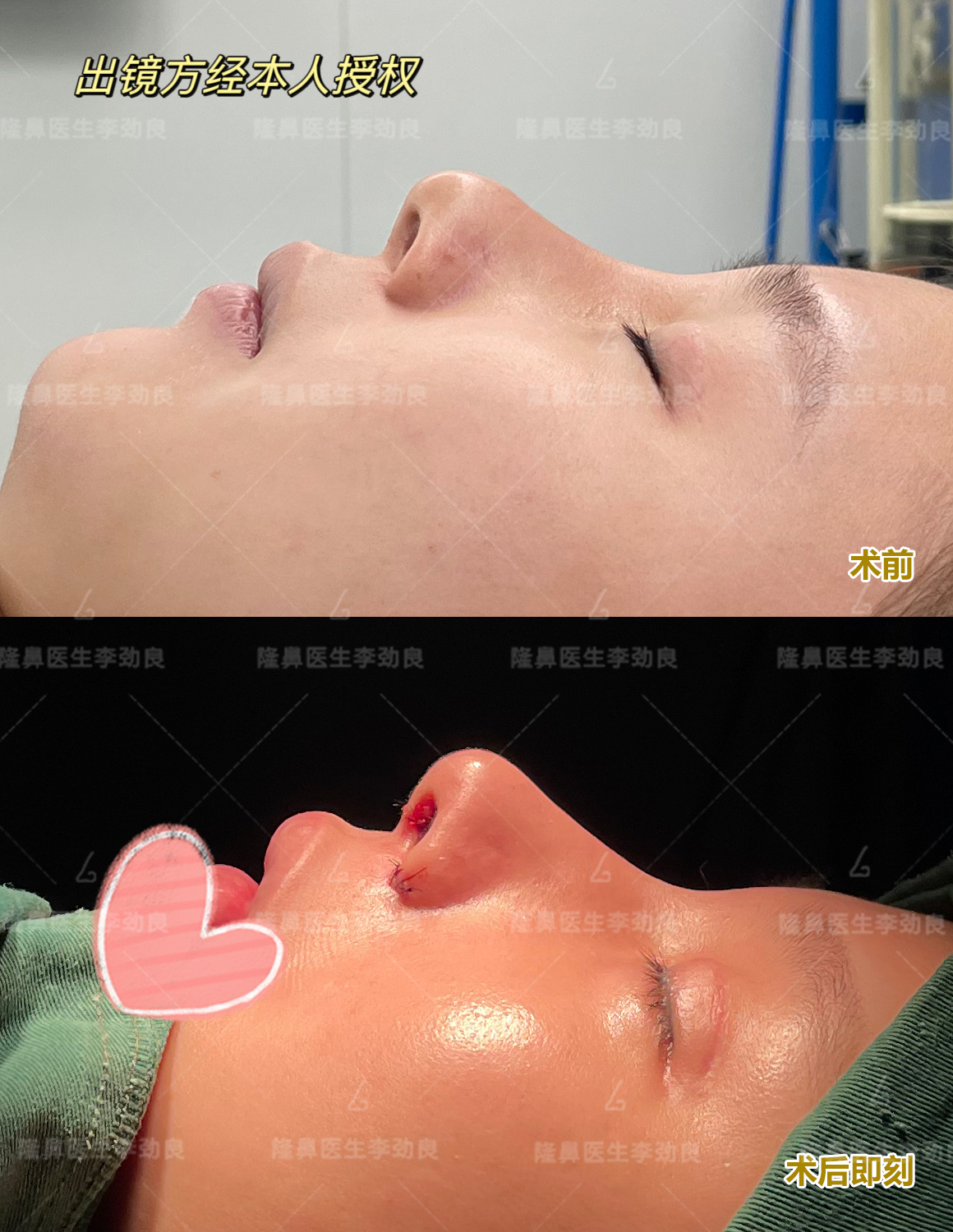 刚做完第3次鼻修复,假鼻子变自然了,值了!