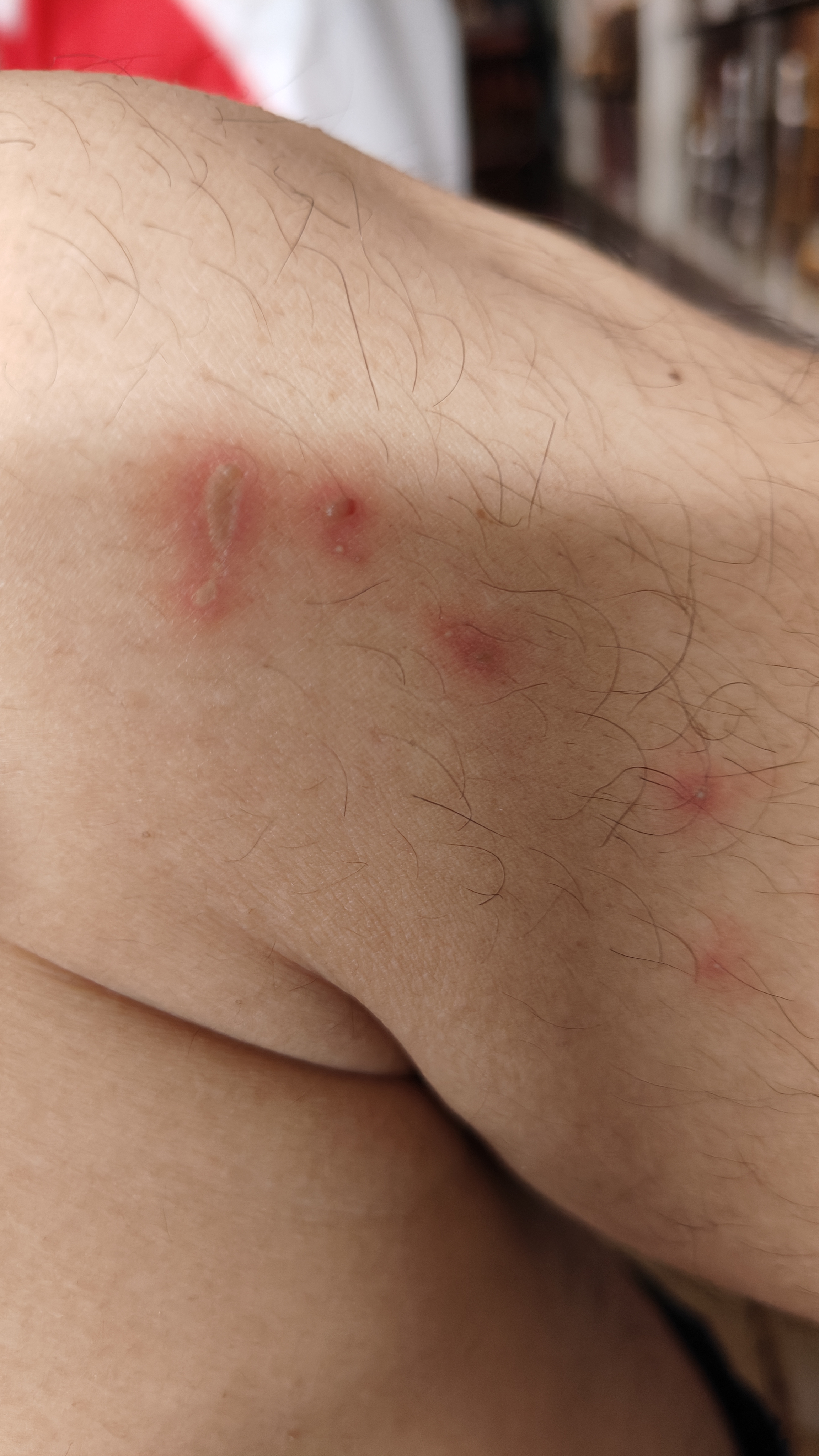 昨晚不知道被什么毒虫咬一口,这坨看着就毒,却不痒