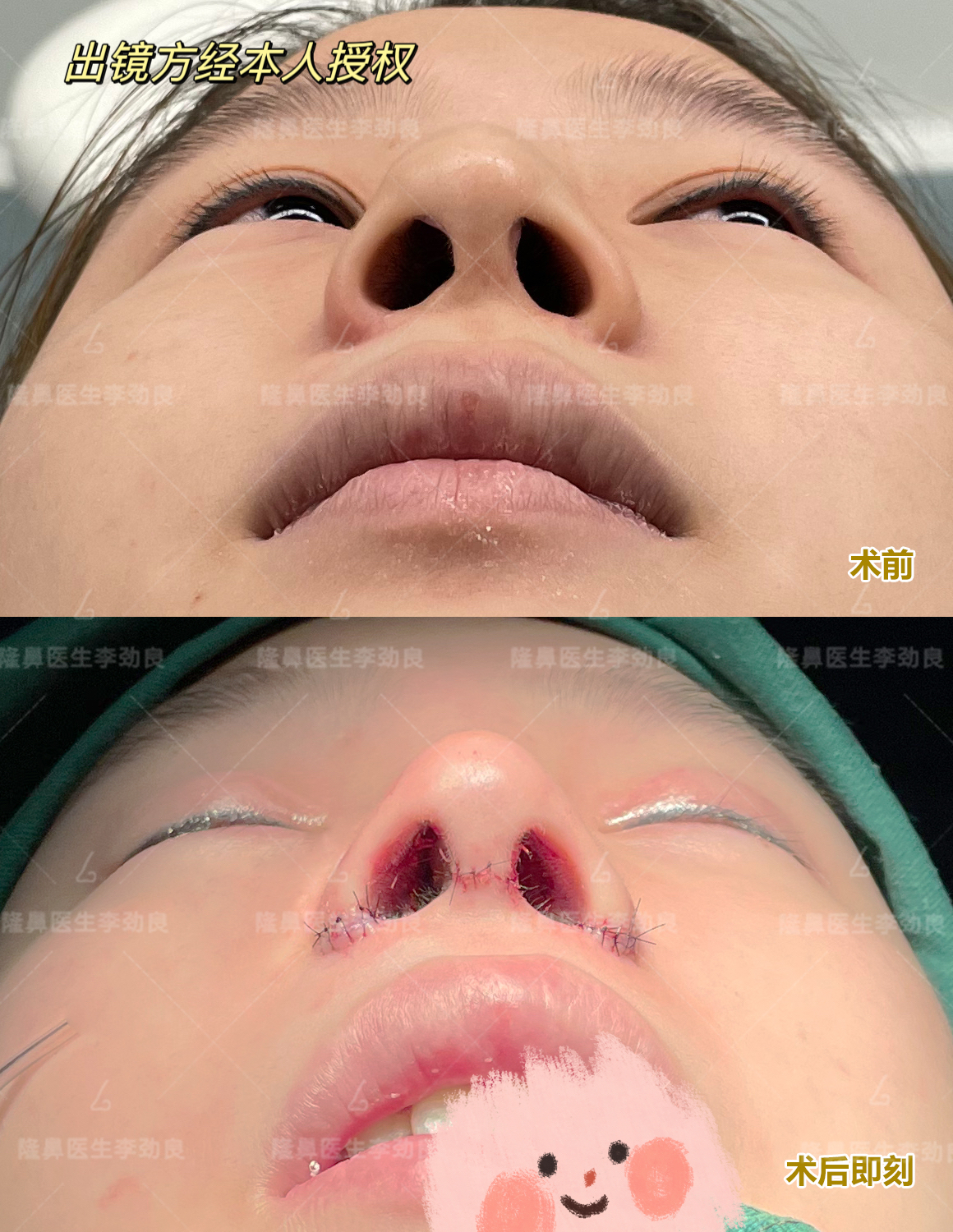 刚做完第3次鼻修复,假鼻子变自然了,值了!