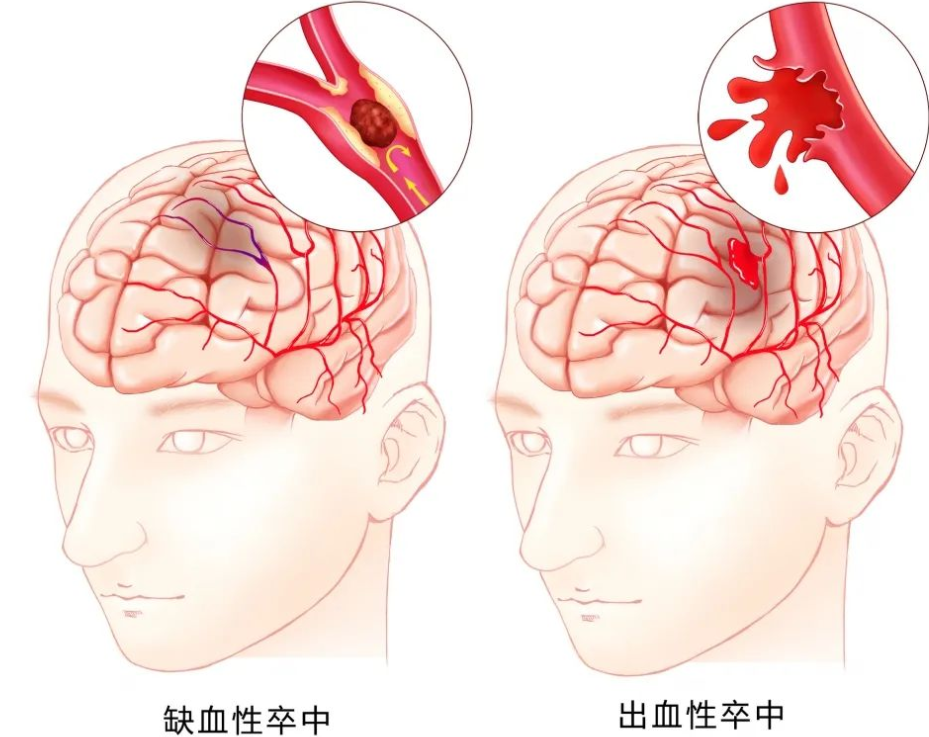 什么是脑卒中的一级预防和二级预防?