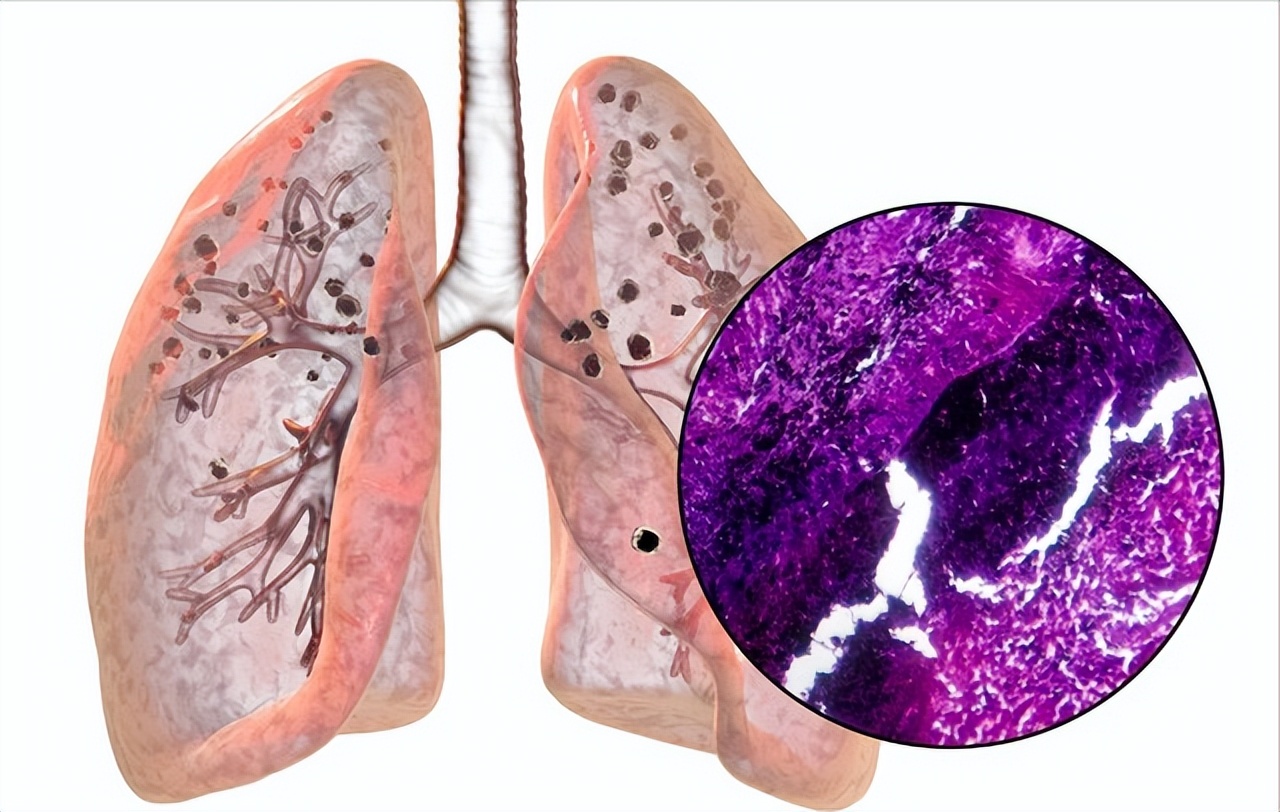 肺癌晚期肺的图片图片