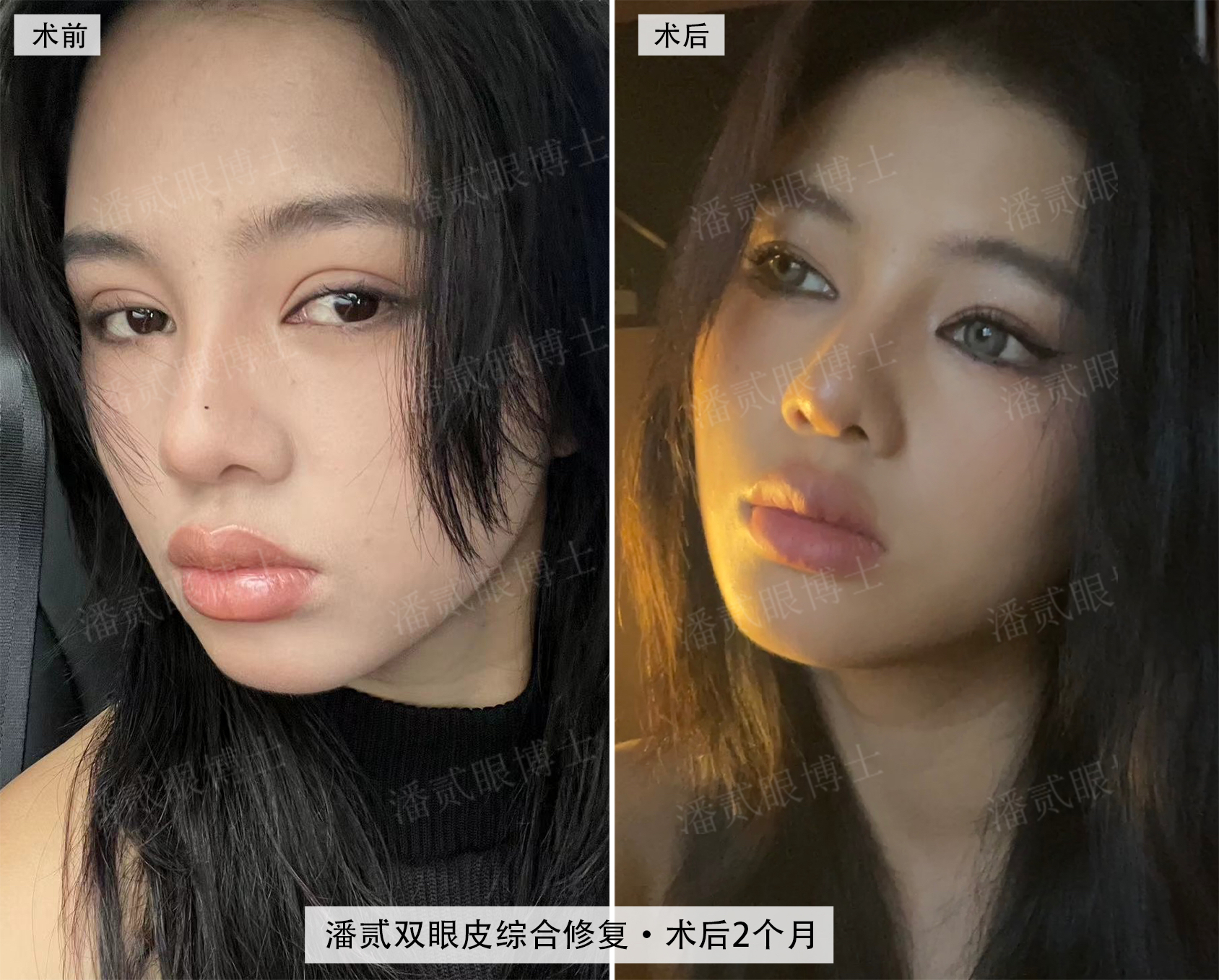 这样的网红同款欧式大平行双眼皮,是你想要的吗?
