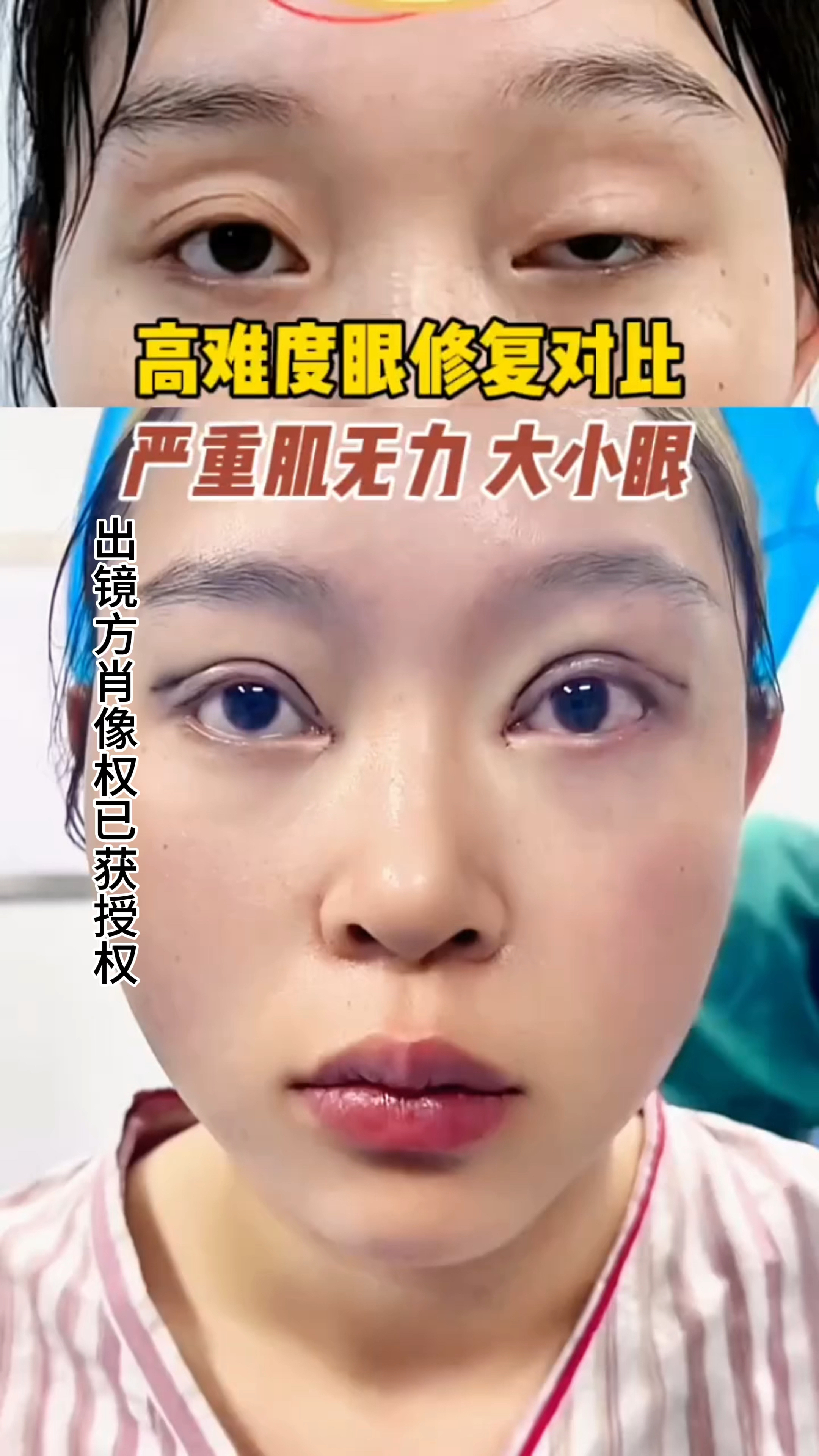 高难度眼修复对比,严重肌无力大小眼