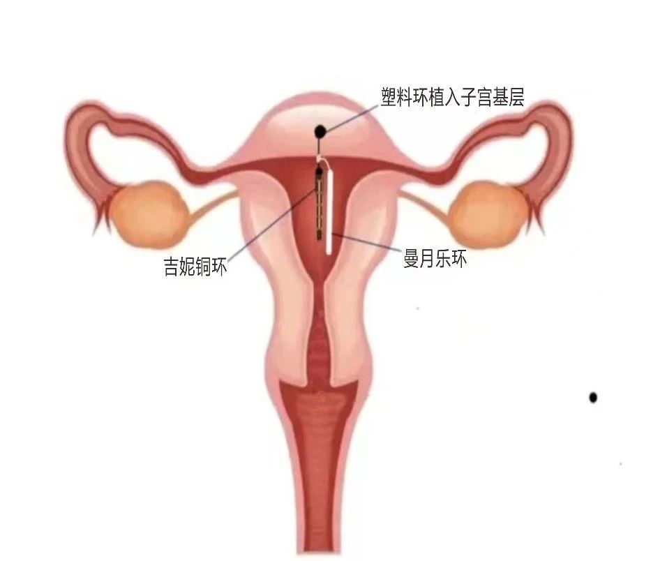 r型环在子宫里的图片图片