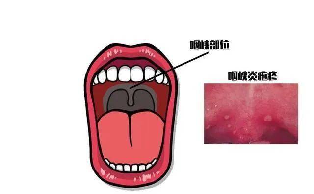 小孩咽喉炎症状及表现图片