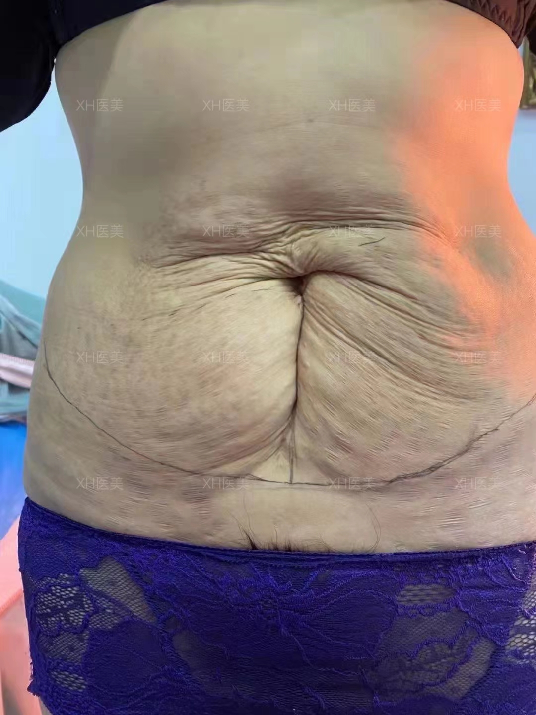 腹壁成形术的几种手术选择依据具体有几种手术选择