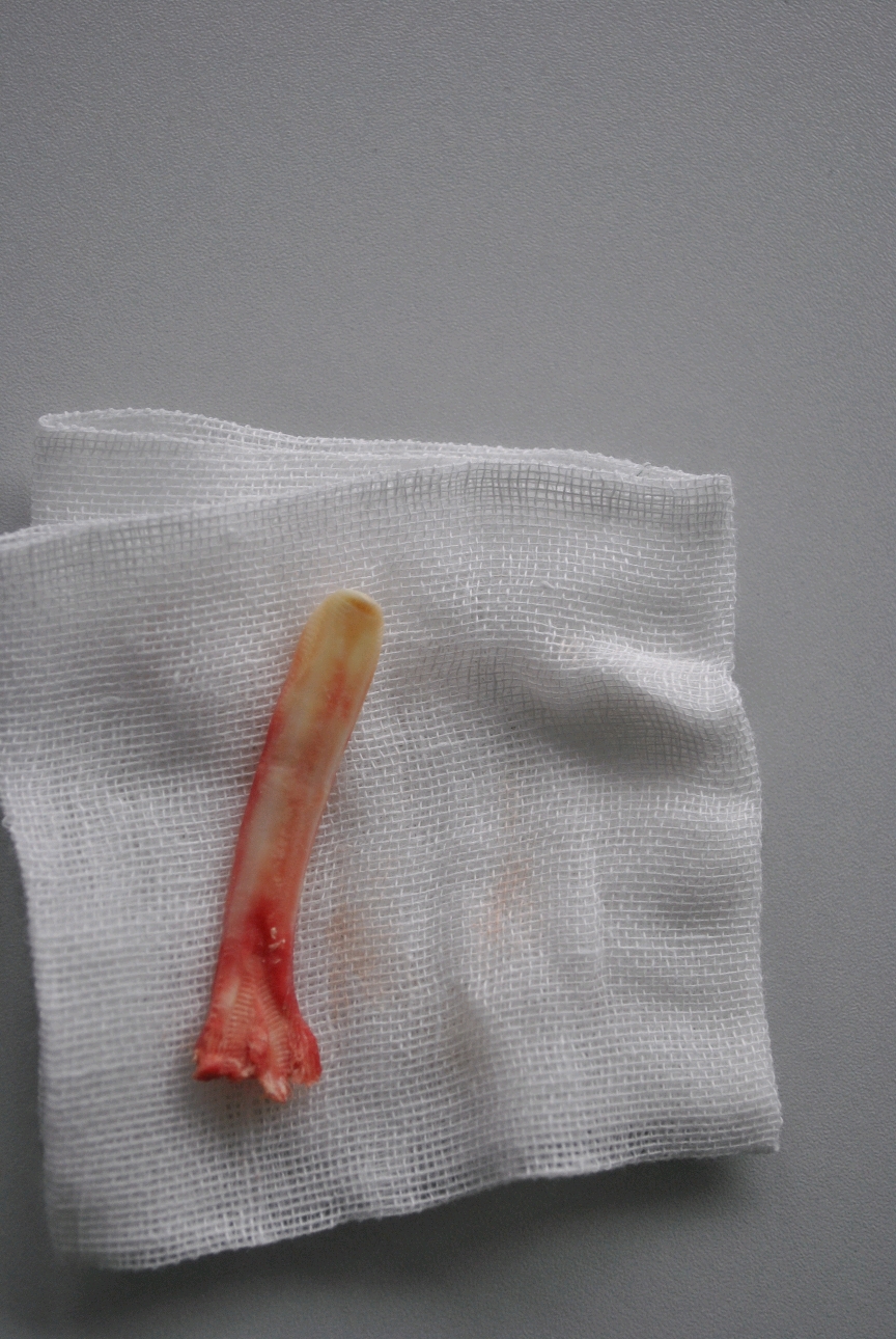 没想到6年前做的膨体隆鼻还会感染,鼻子不仅红肿还会偶尔失去感觉.