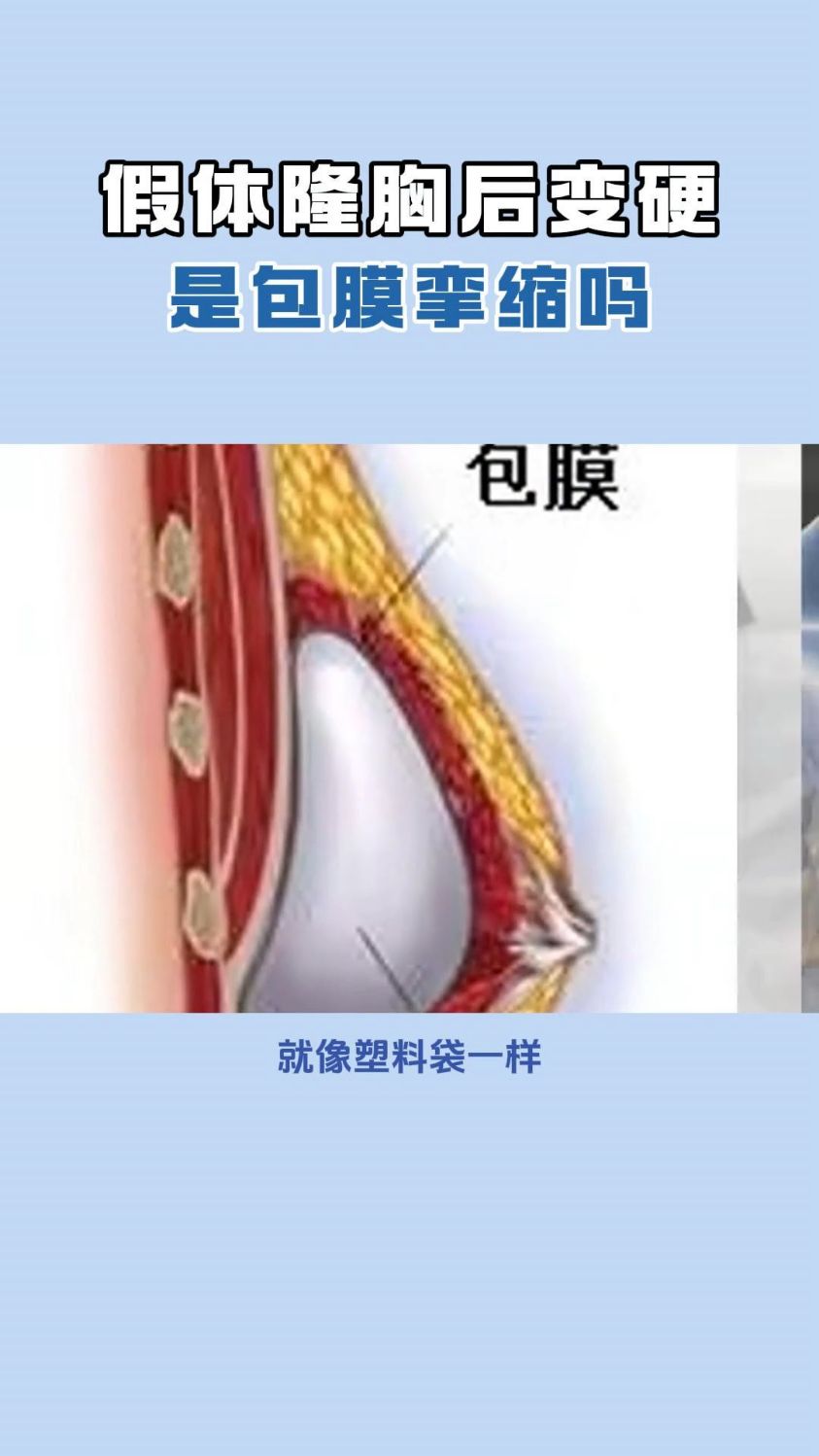 假体隆胸包膜挛缩表现图片