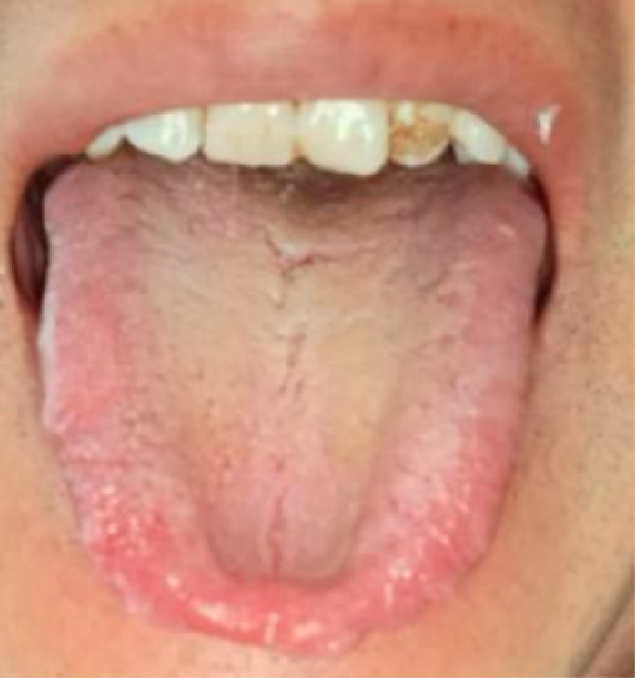 中医祛痰名方,帮你清扫黄痰,黏痰!