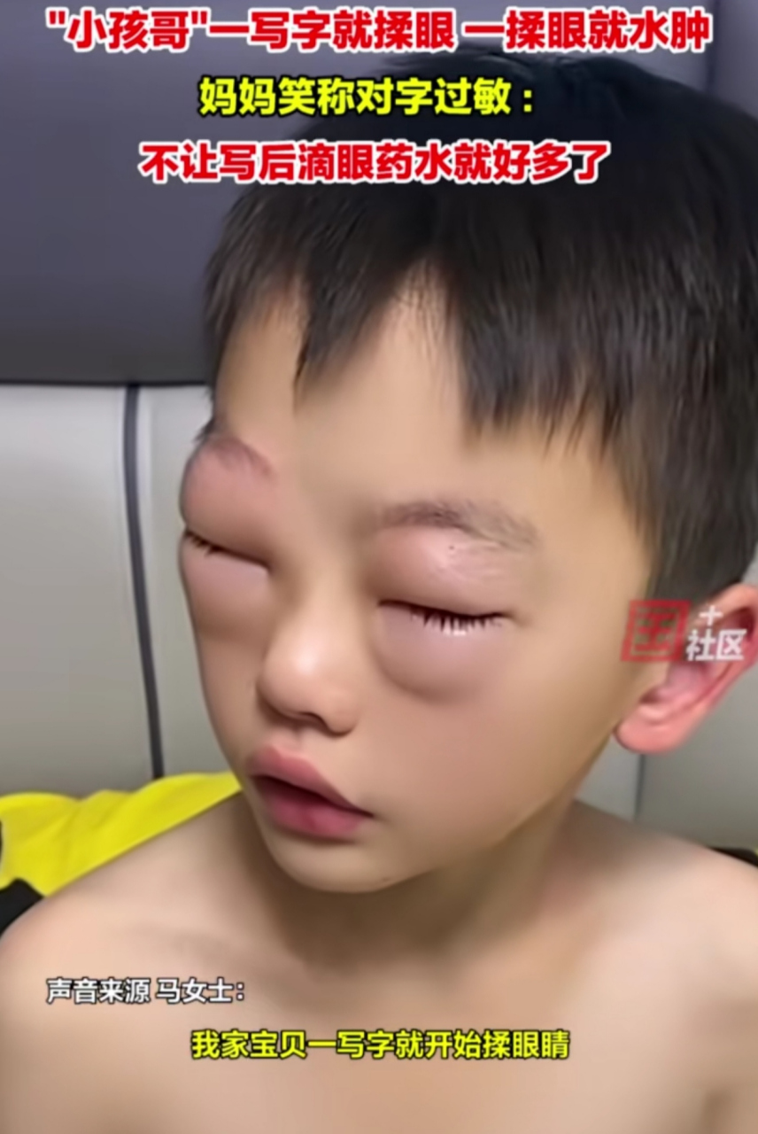 男孩不愿写作业揉眼 双眼肿成悲伤蛙 网友:小孩的世界真的搞不懂,眼睛