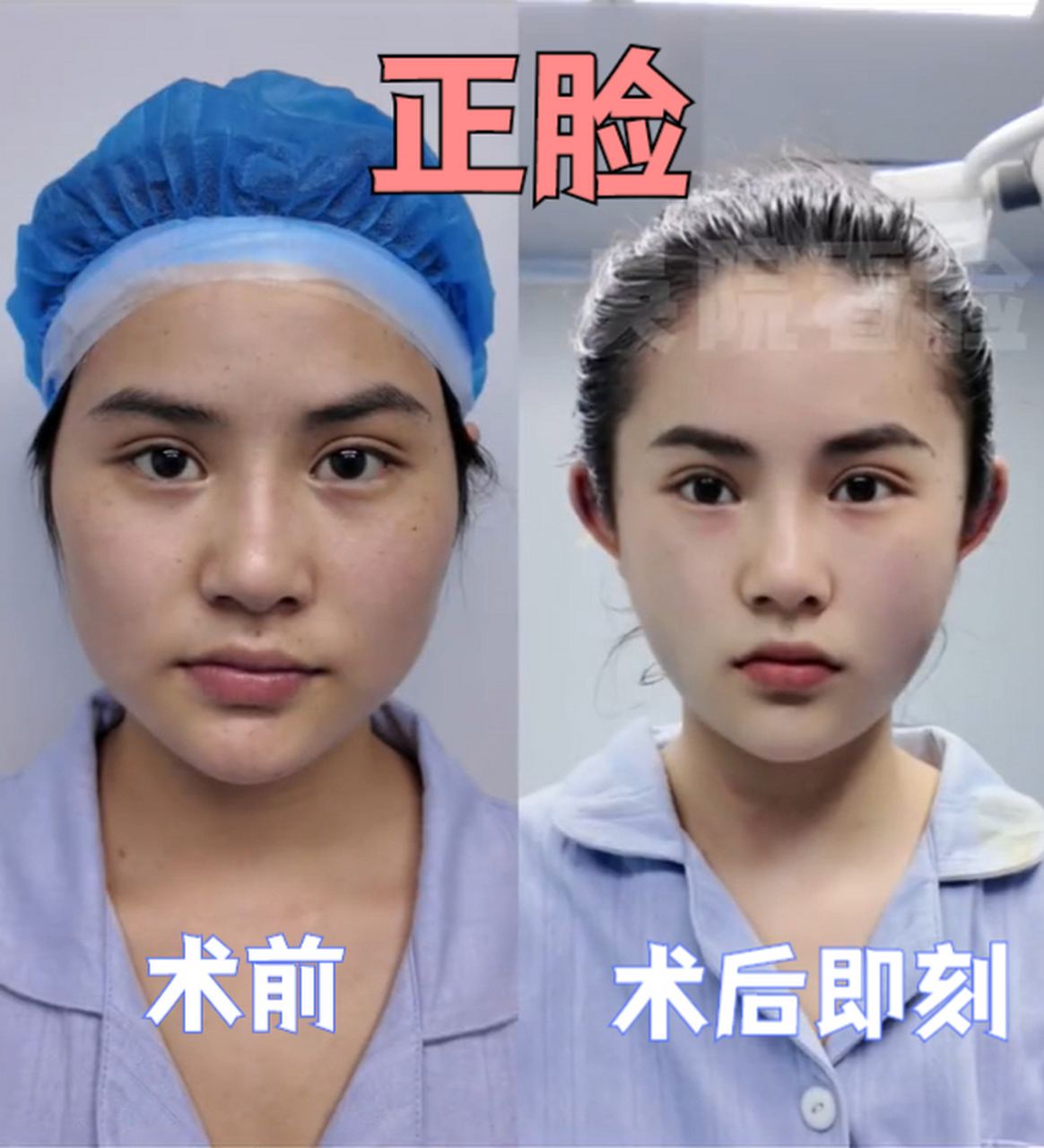 "微创降颧骨颧弓"改脸型,真的可以媲美磨骨吗?