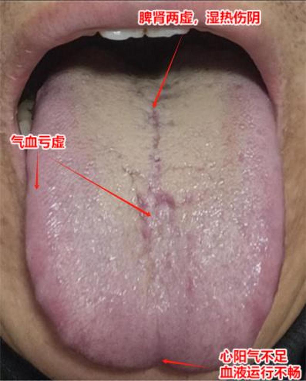 这种舌头,你再拖下去,下一步就是淤血,血管堵塞! 为什么这样说呢?