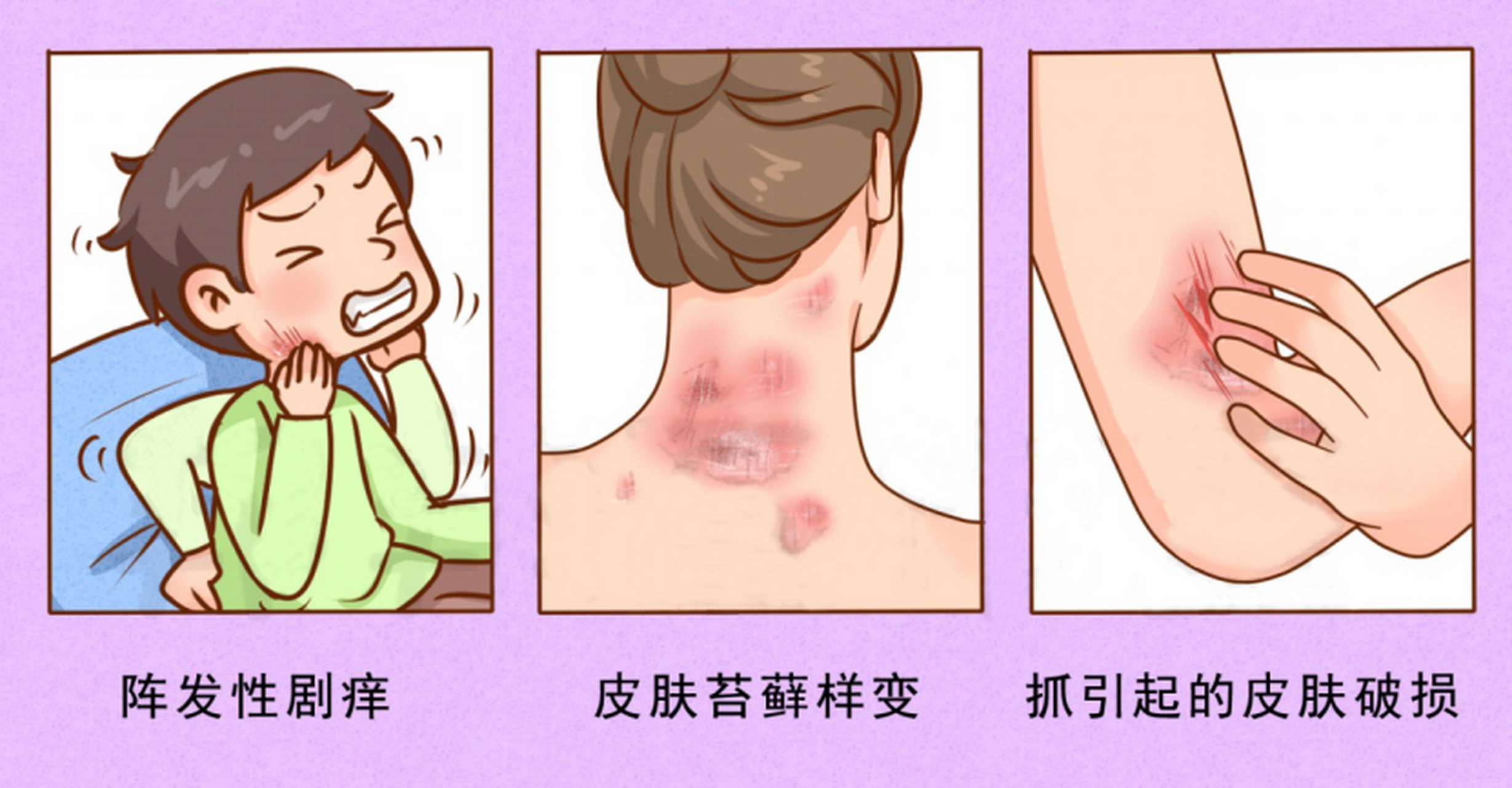 神经性皮炎# ,病情不大却很烦人,奇痒难忍使人夜