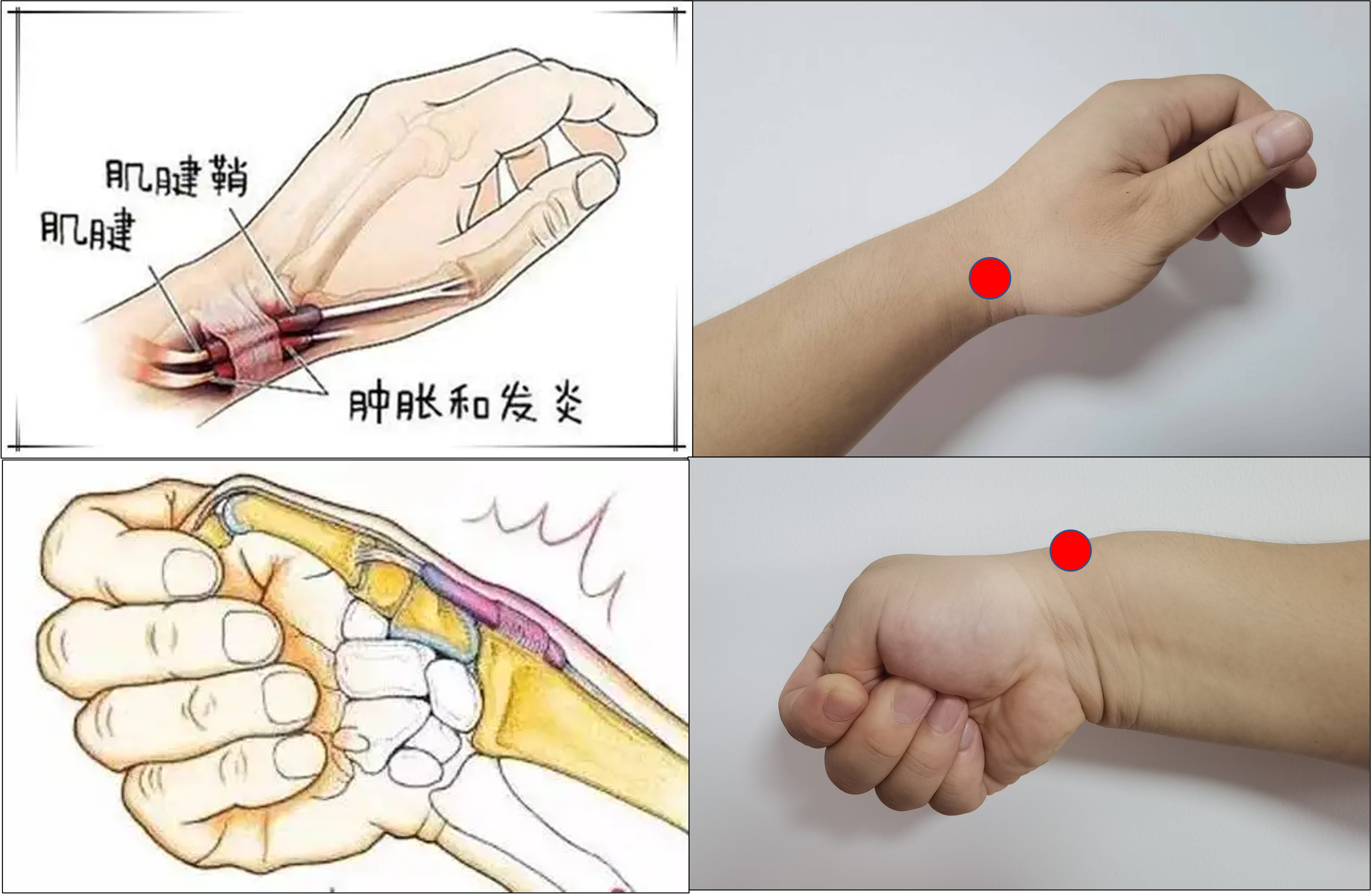 手掌无名指腱鞘炎图片图片