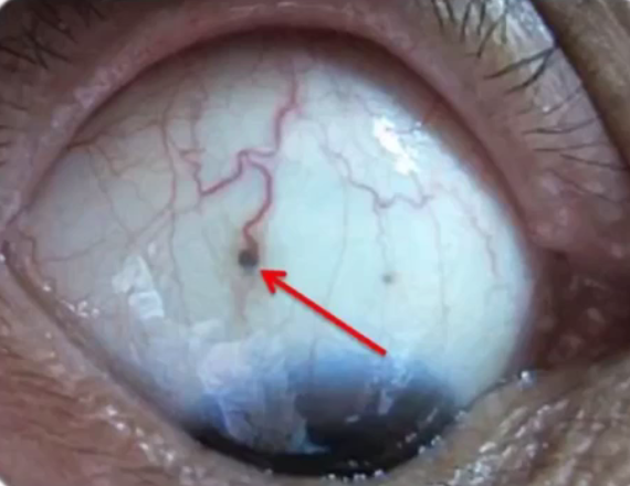 白睛区,黑点和黑圈的临床诊断意义