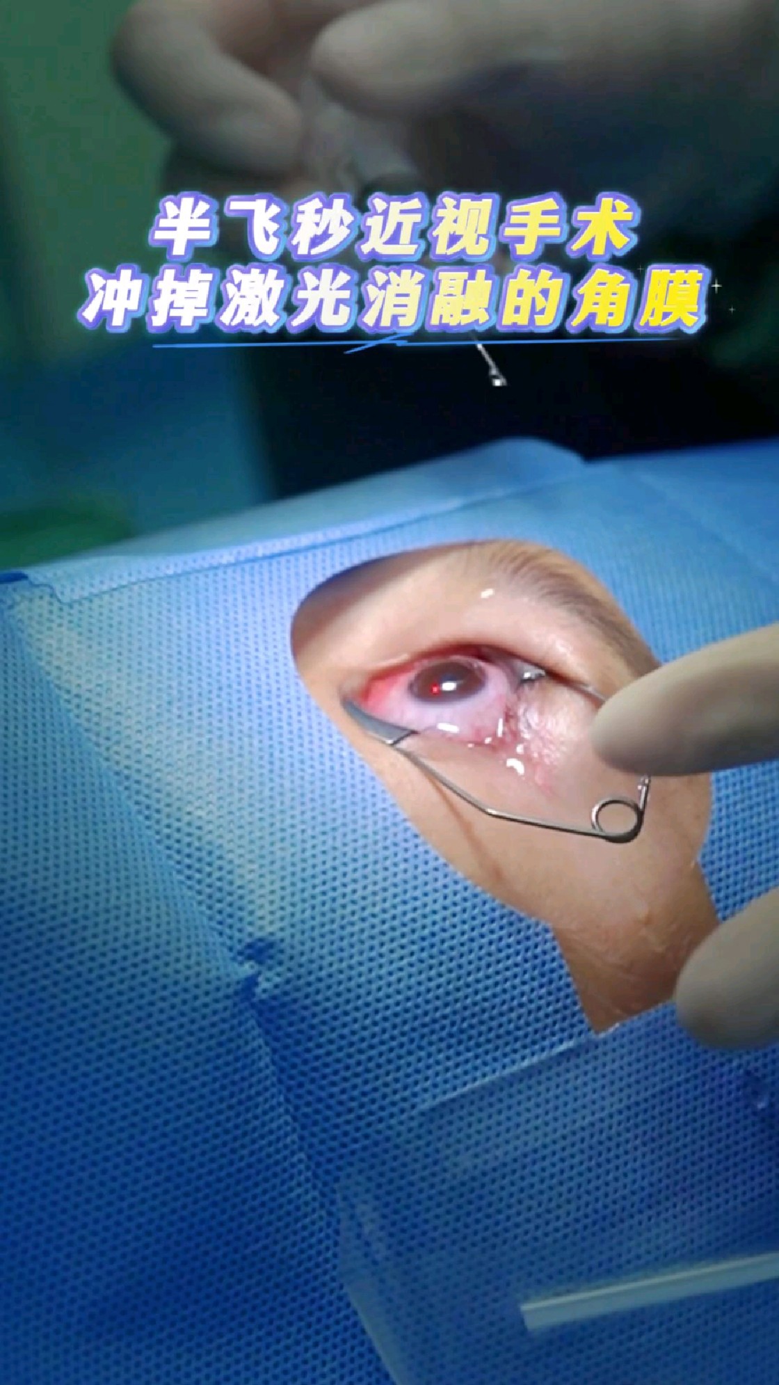 半飞秒激光手术,生理盐水冲洗掉激光消融的角膜