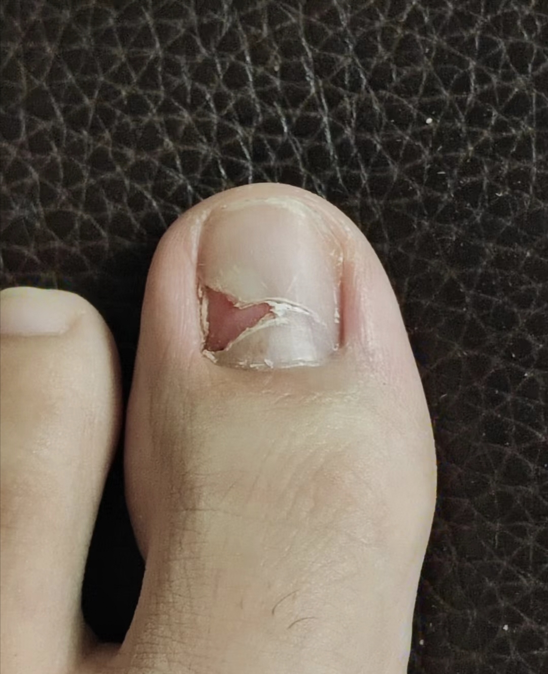 我家神兽的脚趾,说是被碰了一下,有一些液体弄出来了,没怎么疼?