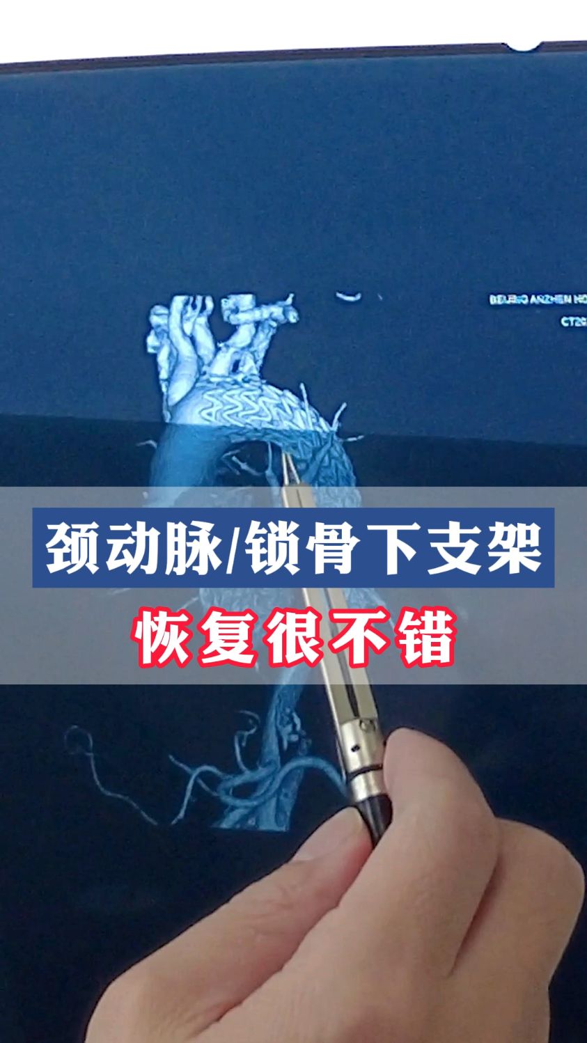 颈动脉和锁骨下动脉放支架,恢复不错