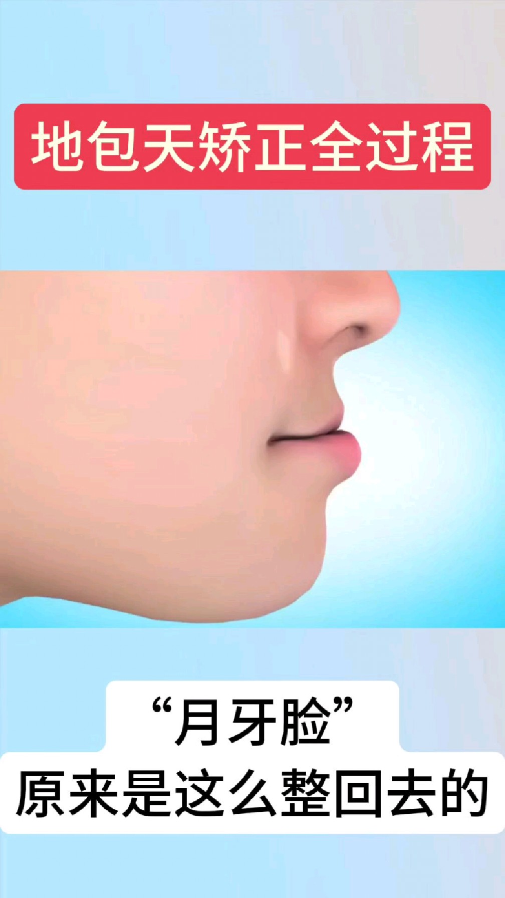 地包天矫正全过程,掰正你的月牙脸