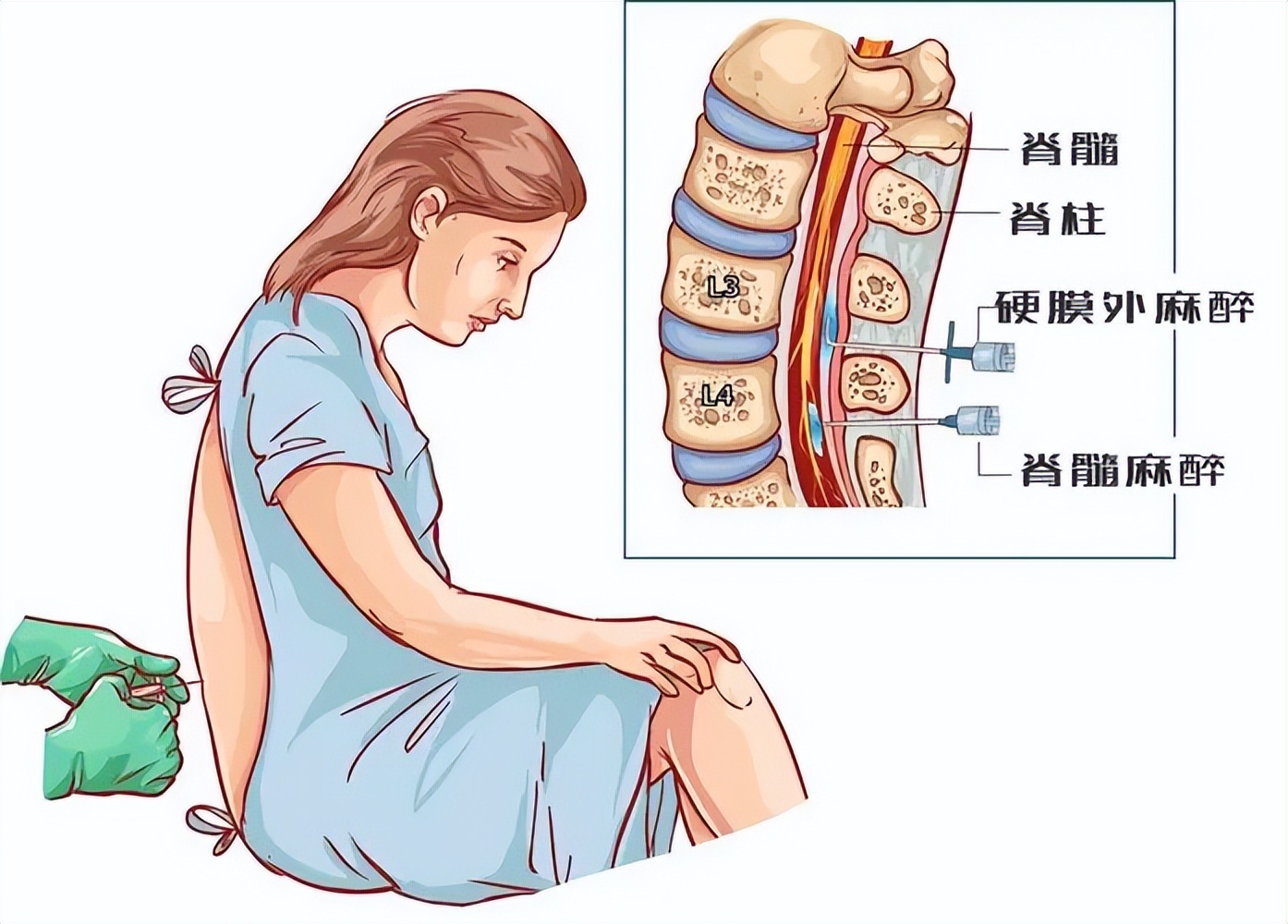 半麻局麻神经阻滞傻傻分不清?到底哪个效果好?看这一篇就够了