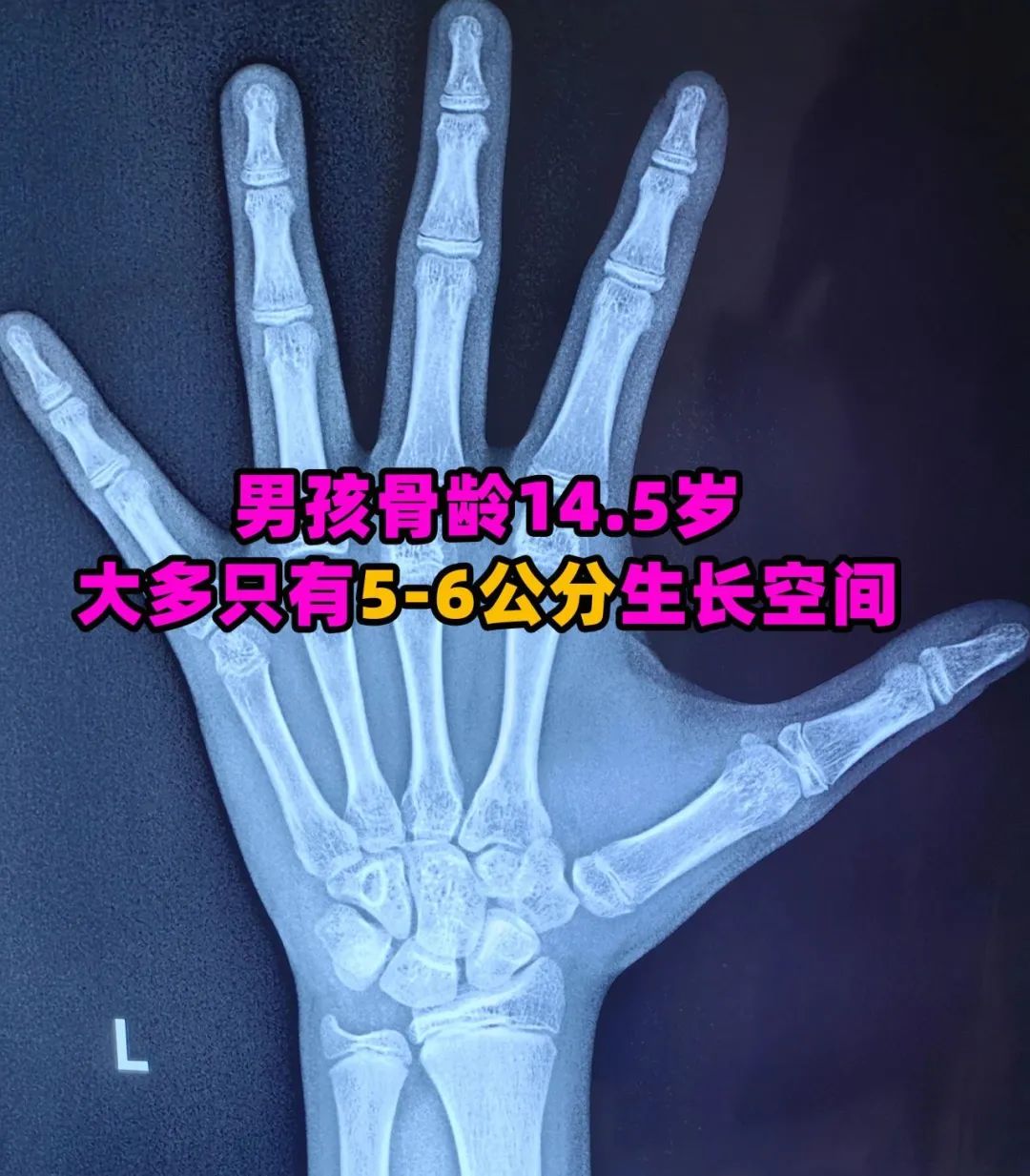 青春期男孩发育的5个阶段,如果到这阶段没有168,注定长不到172