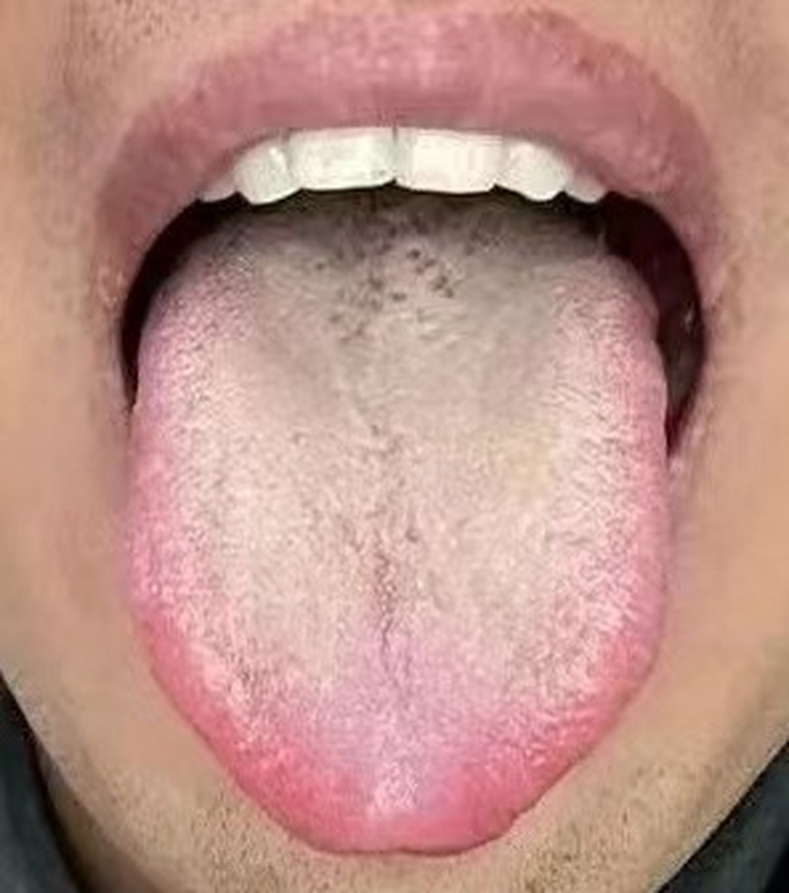 舌中有裂纹,舌苔黄腻——典型的脾虚,体内有湿