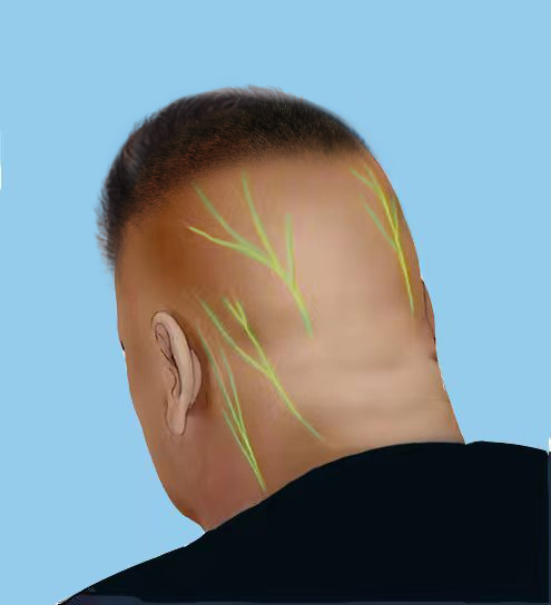 如何鉴别偏头痛和枕神经痛