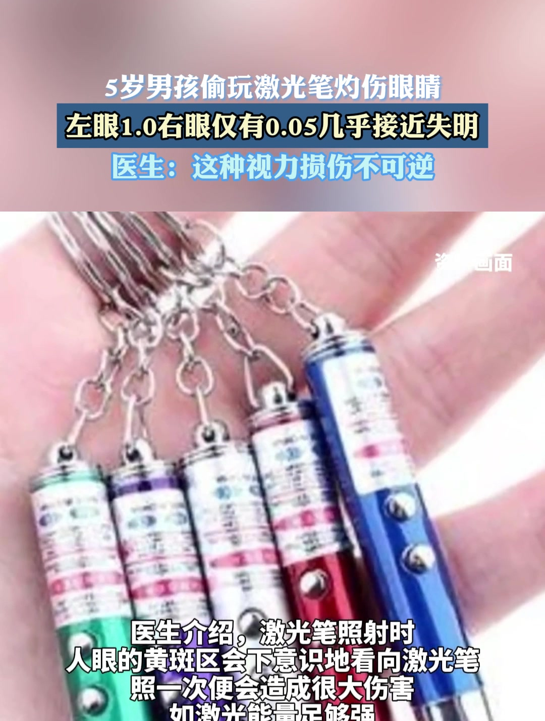 5岁男孩偷玩激光笔灼伤眼睛左眼1.0右眼仅有0.05几乎接近失明