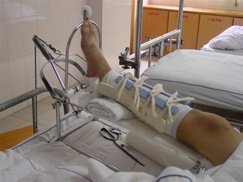 案例回顾:男子怀疑妻子与人暧昧持刀追赶对方,对方摔骨折后索赔