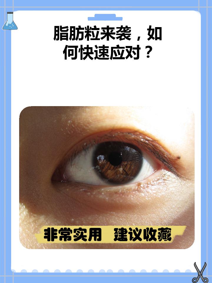 今天,我想和大家聊聊一个常见的眼部问题——眼睑上的脂肪粒.