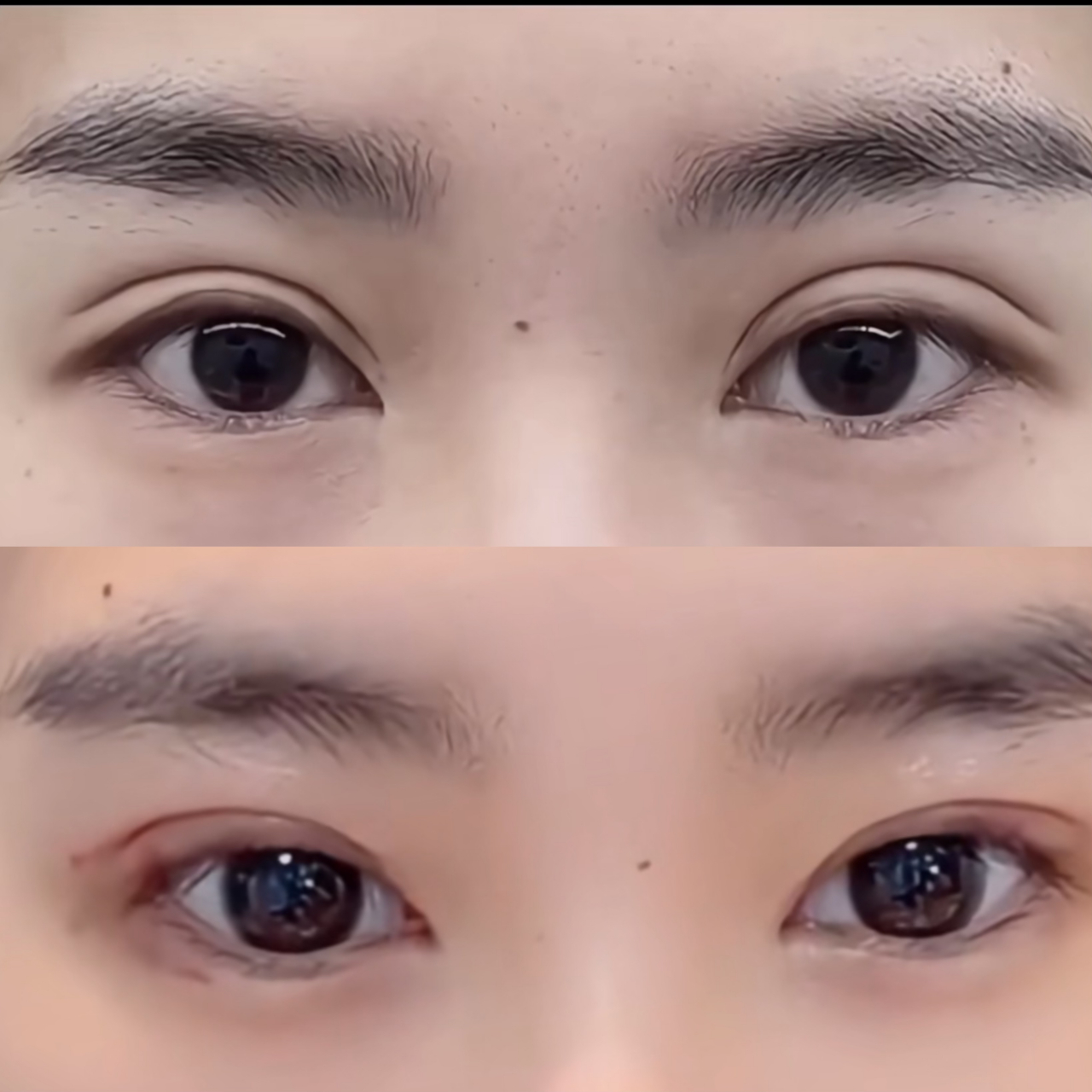 来北京修复双眼皮宽改窄,术后双眼皮宽度降低,自然开扇,妈生幼态,恢复