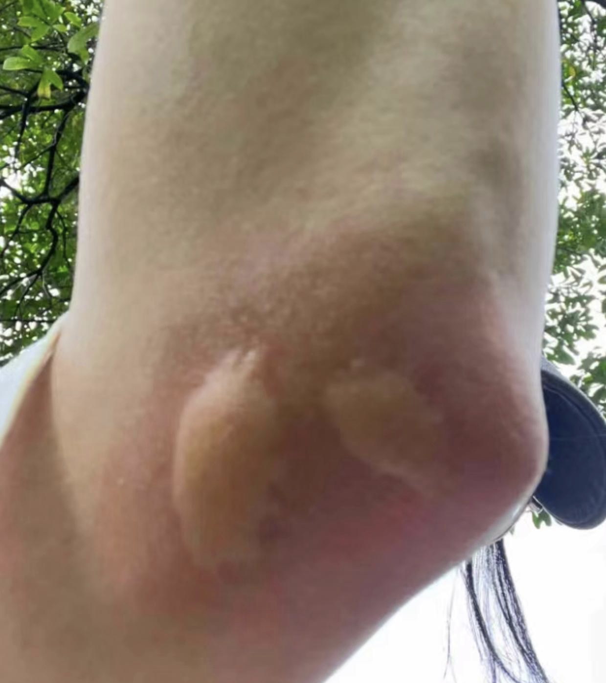这夏天的蚊子也太狠太毒了!