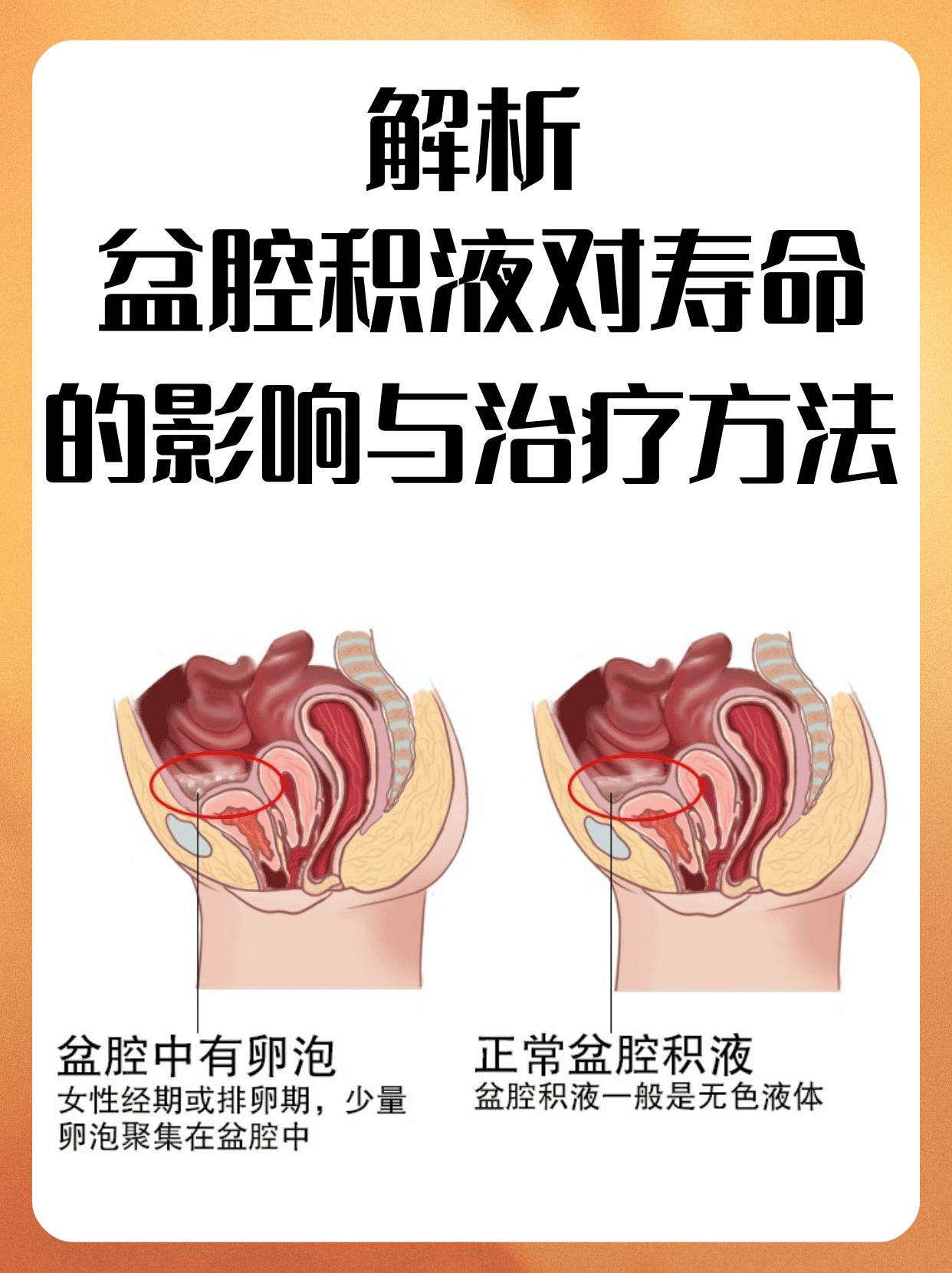 今天我们来聊聊一个女性朋友们可能比较关心的问题——盆腔积液