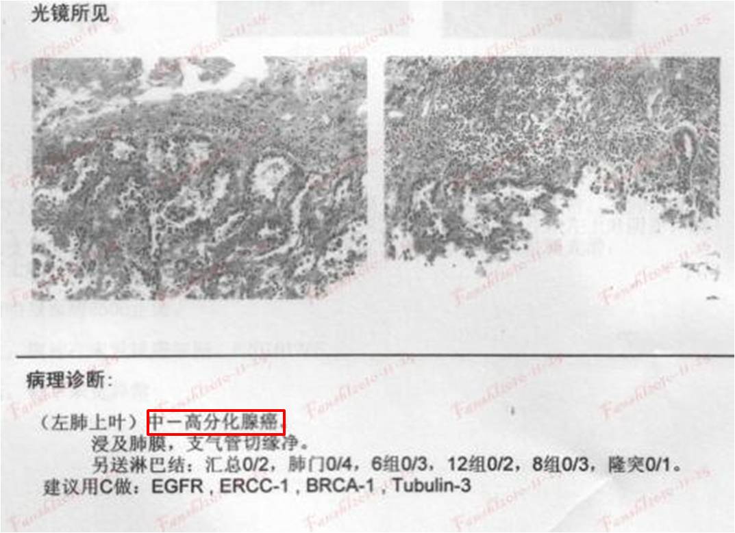 肺癌 病理报告图片