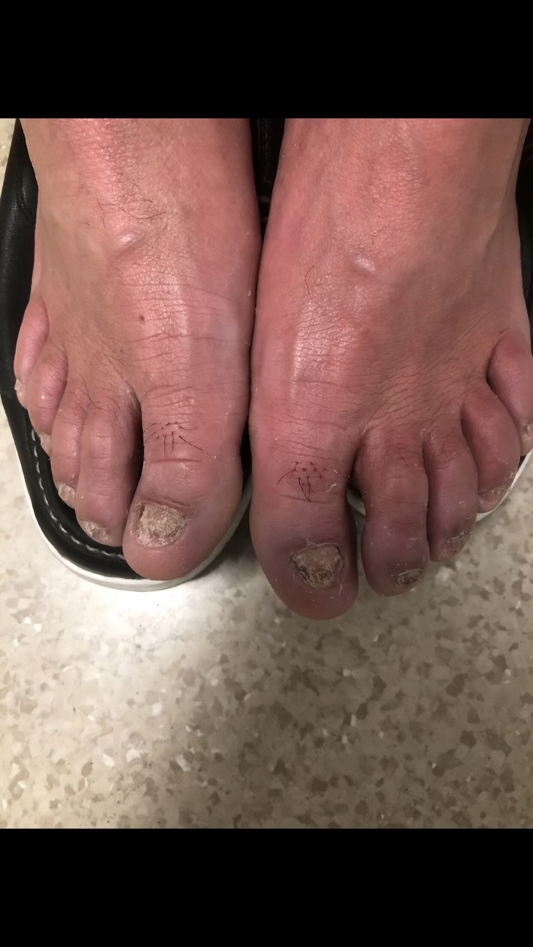 治疗棘手的甲扁平苔藓