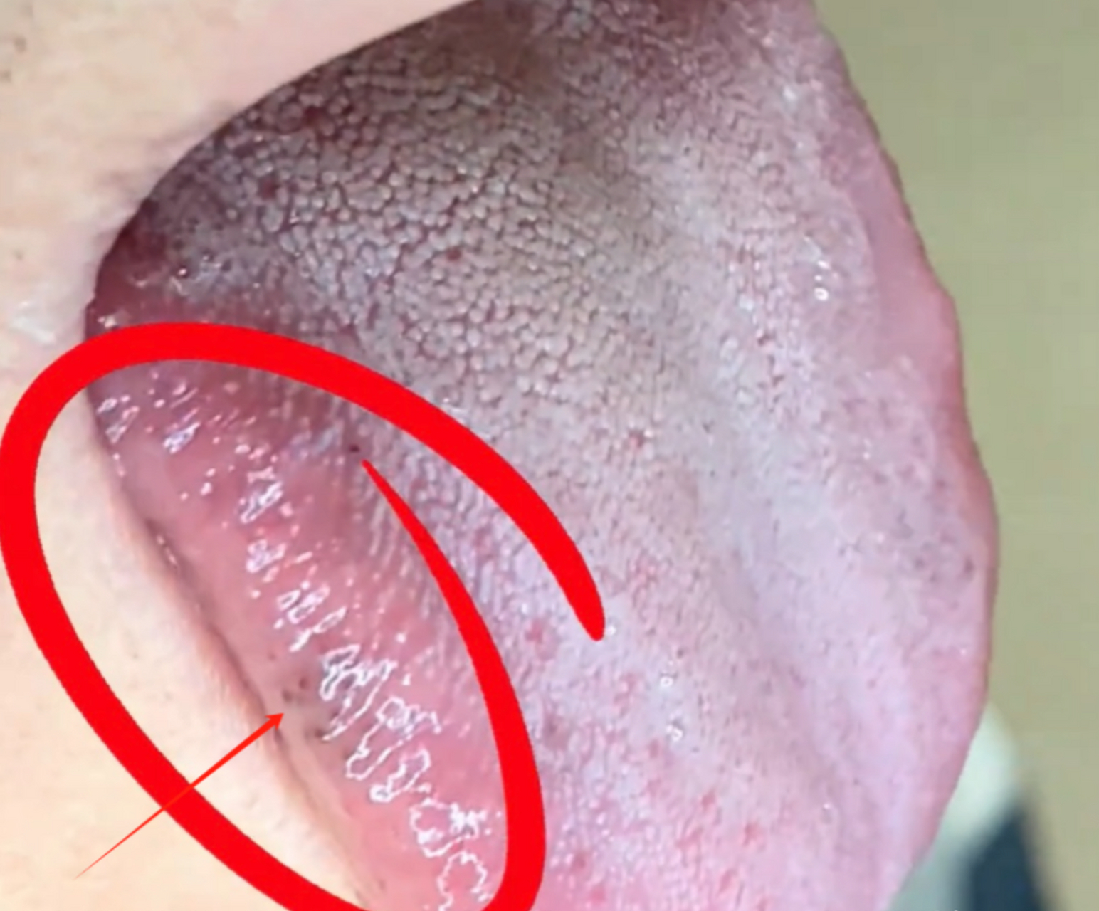 舌两边和下面这个图片一样,有同样的瘀斑或瘀点,而且整个舌质黯淡发紫