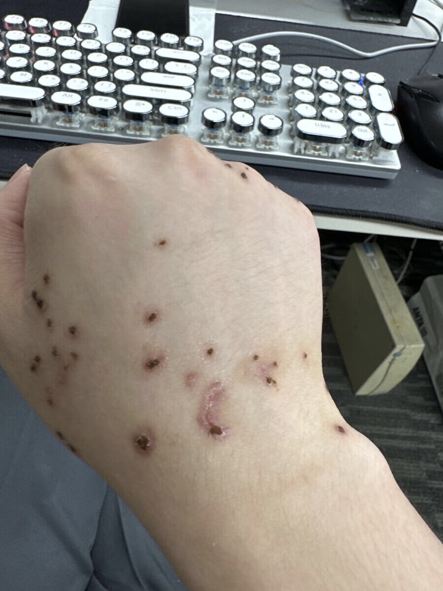 冷冻治疗后结痂