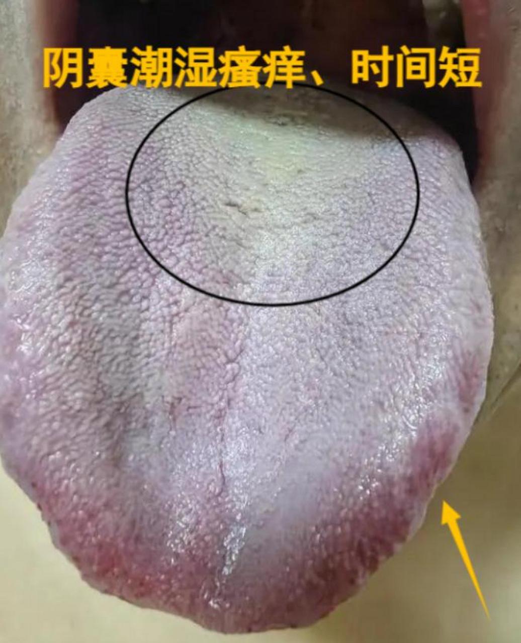 门诊又碰到一个虚不受补的舌象,白苔厚腻如雪,吃了很多补药都无效!