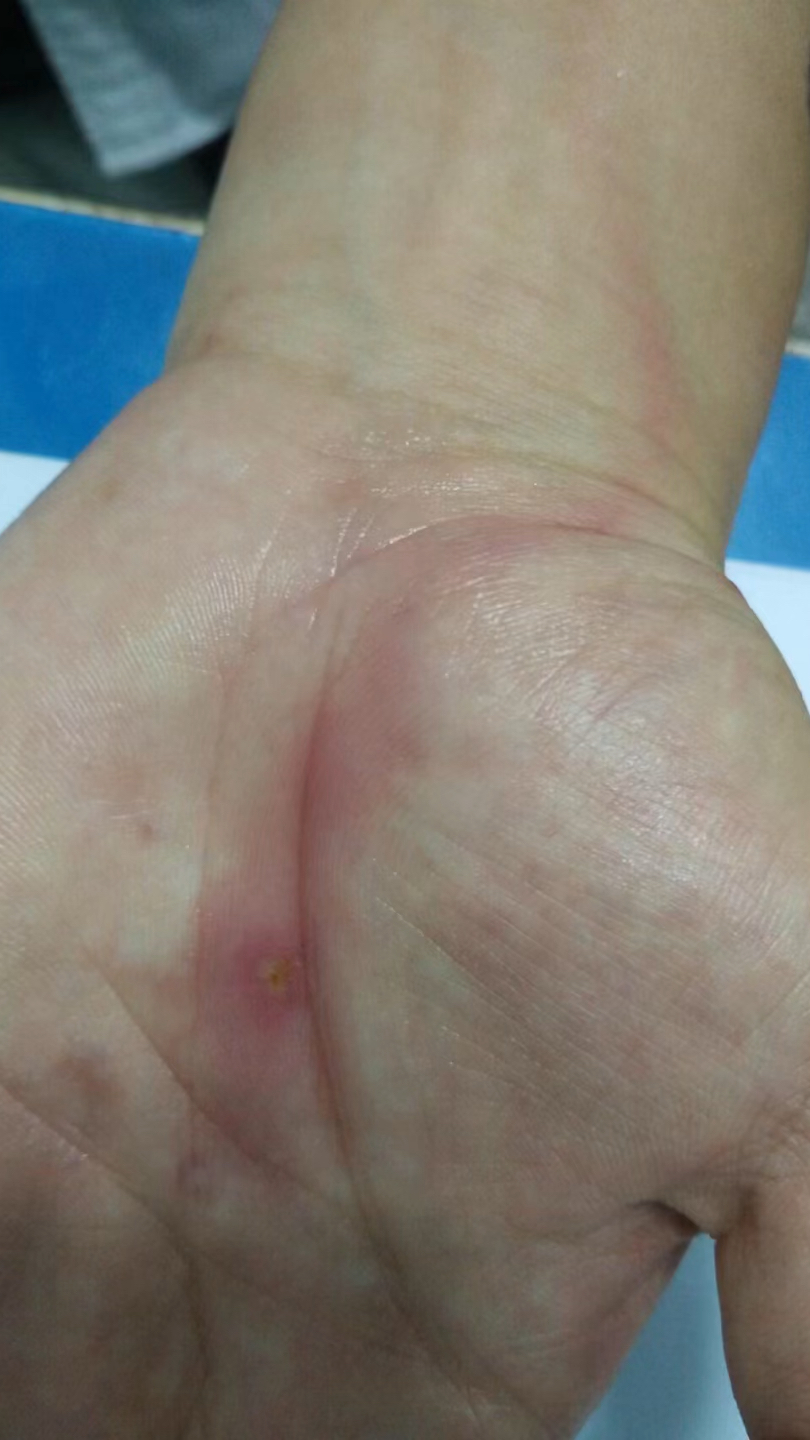 虫咬后继发急性淋巴管炎