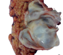 一句话科普:会癌变的粘粘糊糊的胰腺囊腺瘤(313)