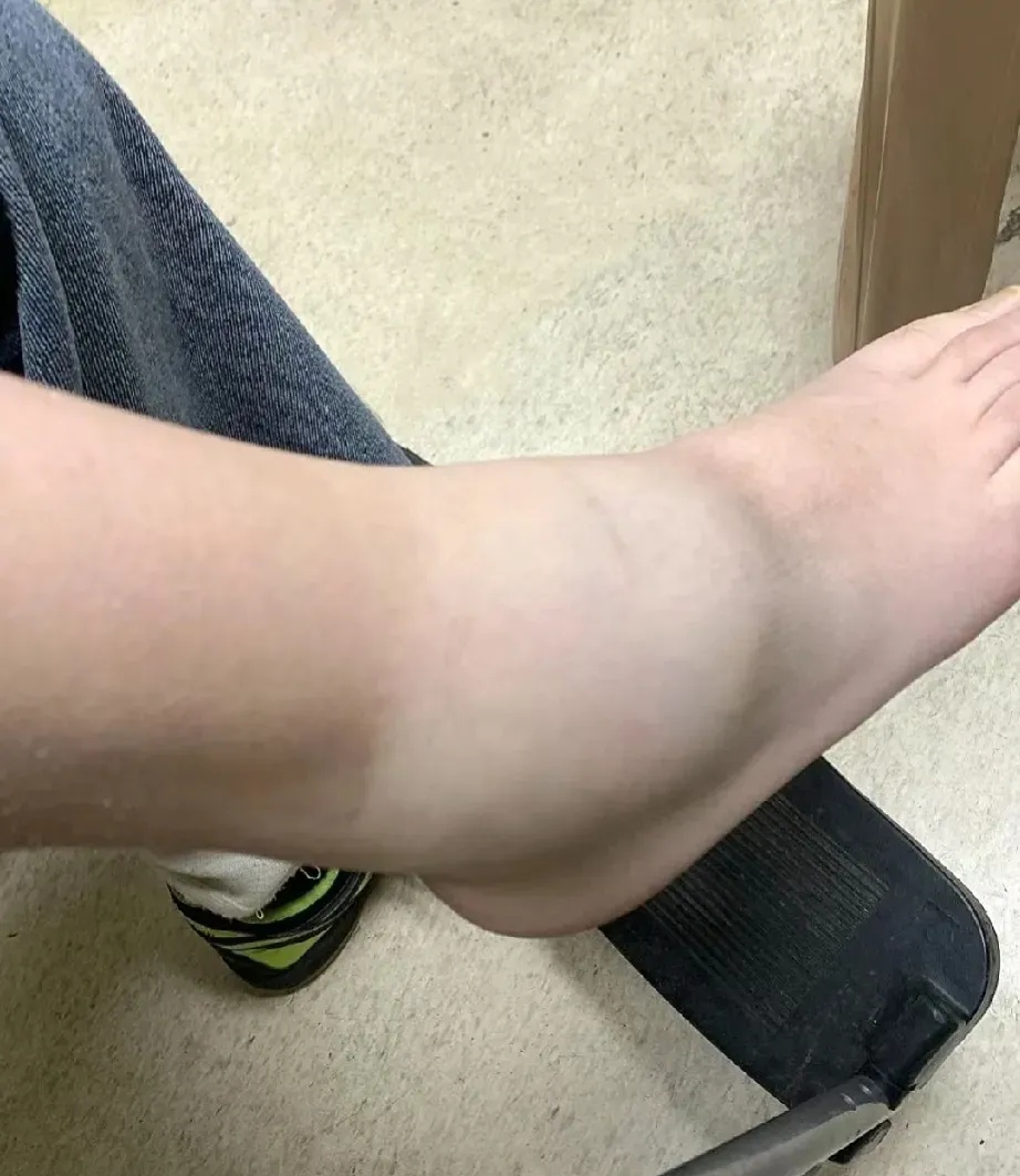 去医院检查,医生说脚扭伤了,休息十天半月就能好