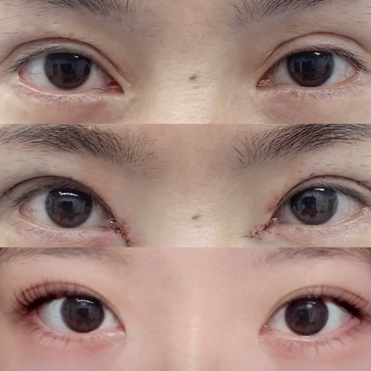 全切双眼皮宽改窄 包眼角,术后三个月,眼睛恢复自然,开扇型双眼皮