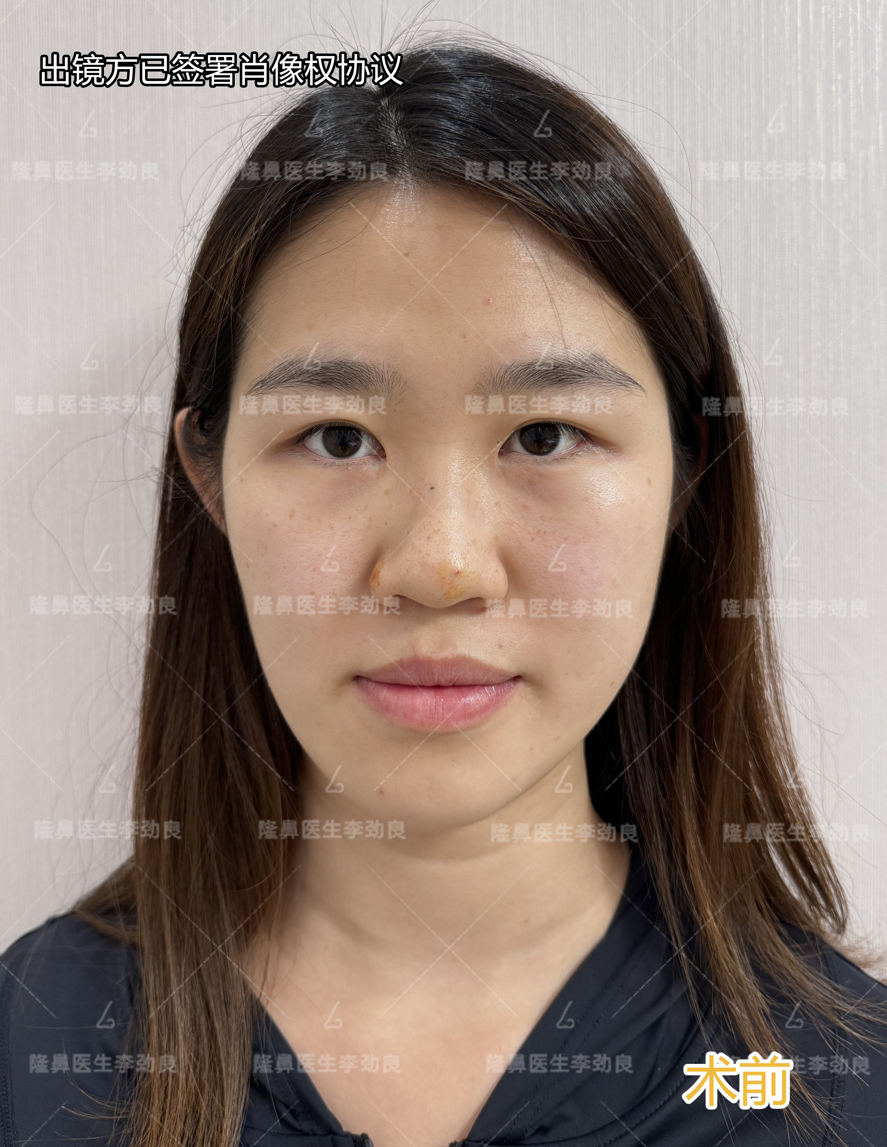 我的诉求就是想把鼻子做立体,但又要自然,加上填充鼻基底,想要把中