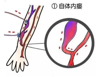 动静脉内瘘 卡通图片