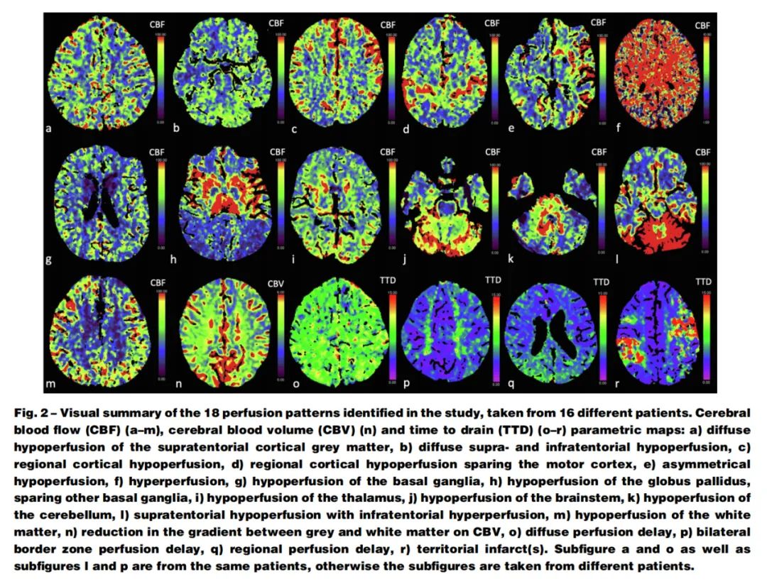 脑灌注成像颜色解读图片